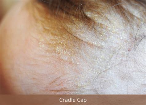 cradle cap in the elderly|Adult Cradle Cap: Information, Treatment, And More.